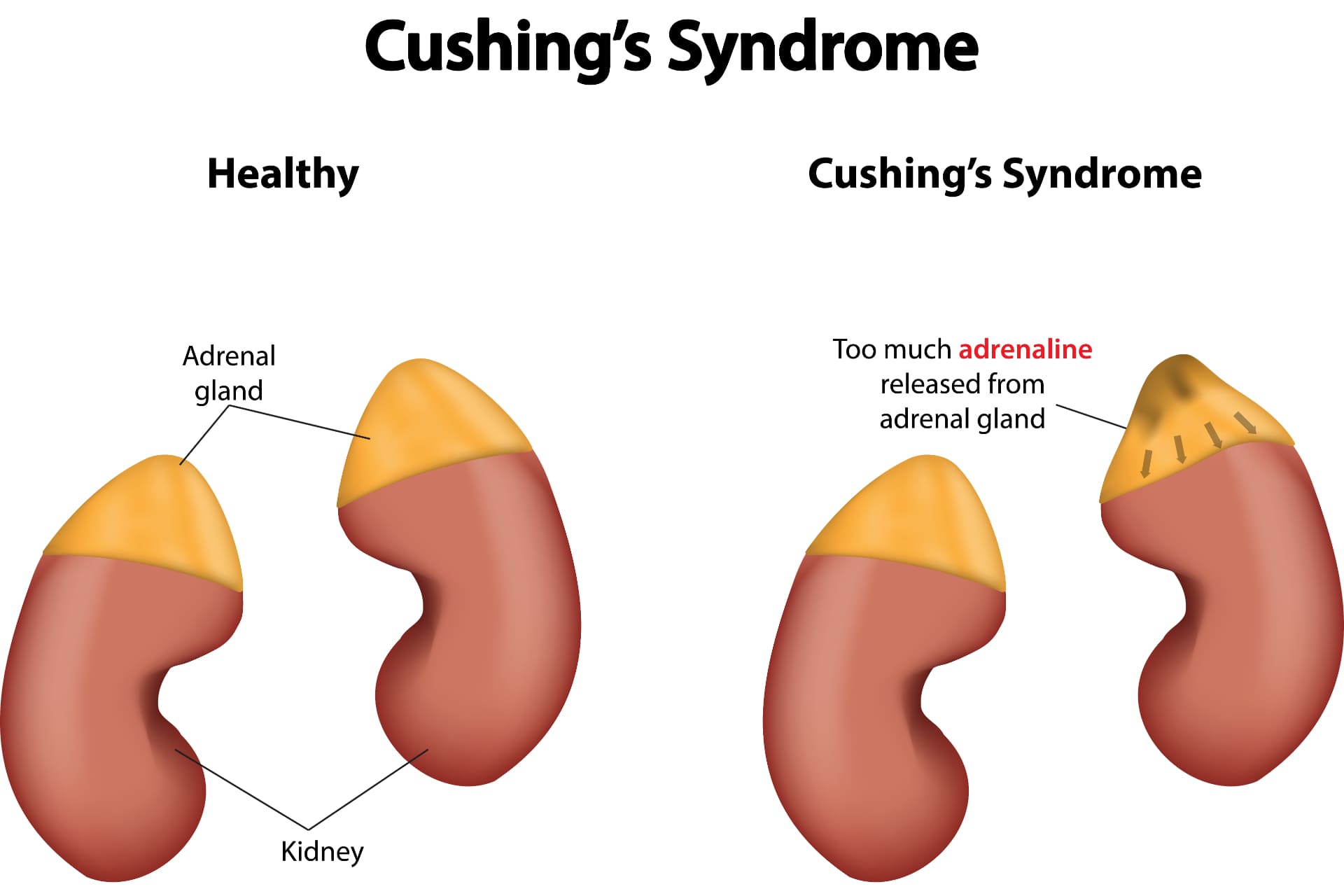 Cushing Sendromu